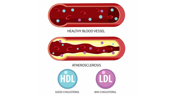 کلسترول HDL و LDL