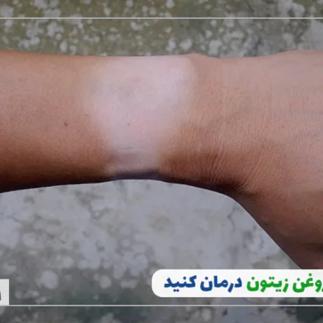 درمان آفتاب سوختگی با روغن زیتون